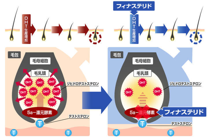 フィナステリドの作用機序