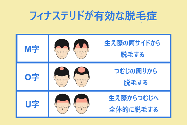 フィンペシアはM字・O字の薄毛に有効！